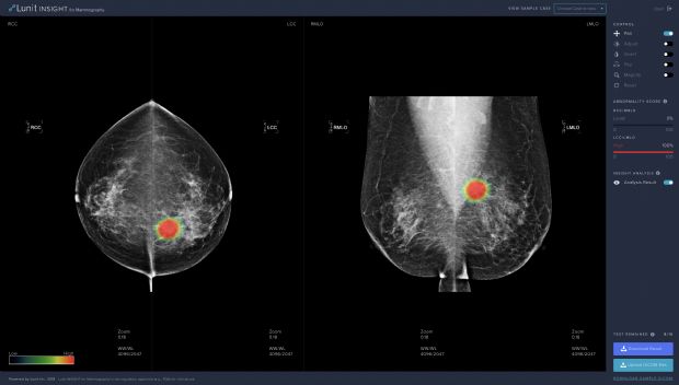 루닛, AI 기반 유방암 진단 보조 소프트웨어 공개