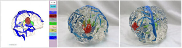 메디컬아이피, 네이처 자매지에 '3D프린팅 뇌종양 모델' 논문 게재