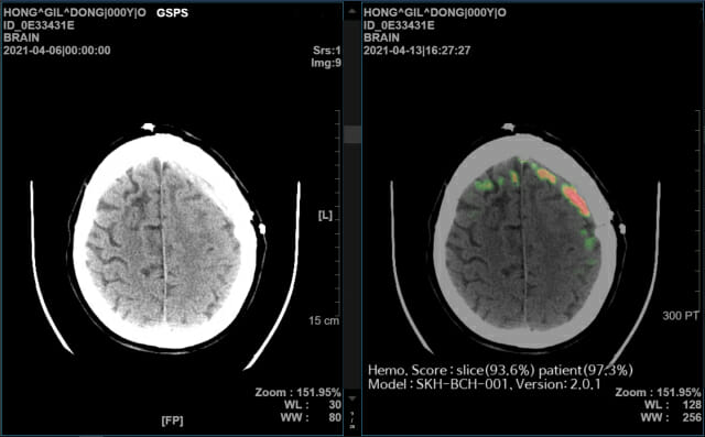 뇌출혈 영상 의료 솔루션 메디컬 인사이트 플러스 뇌출혈 데모 화면(이미지=(SK(주) C&C AI)