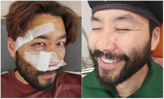 '오토바이 사고' 노홍철, 처참했던 안면부상 얼굴 공개